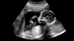 ultrasound image of unborn baby