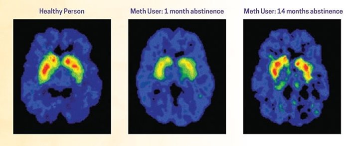 Picture of Brain effected by Meth
